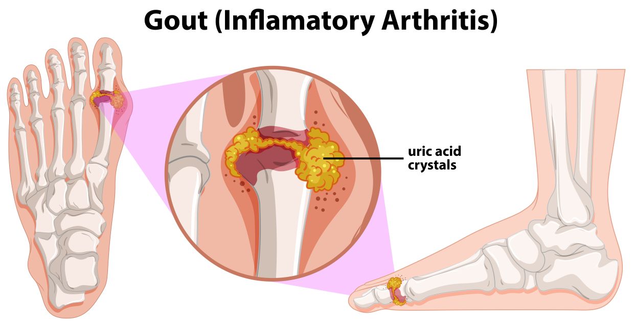 A Human Anatomy of Gout illustration