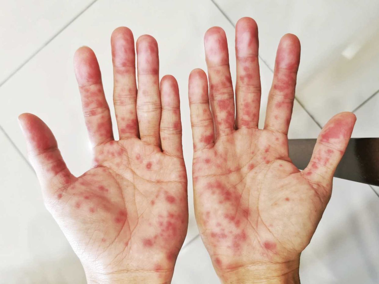 Red spots that swell appear on the palms during initial stage of HFMD infection leading to pain during contact. / star pic by LO TERN CHERN